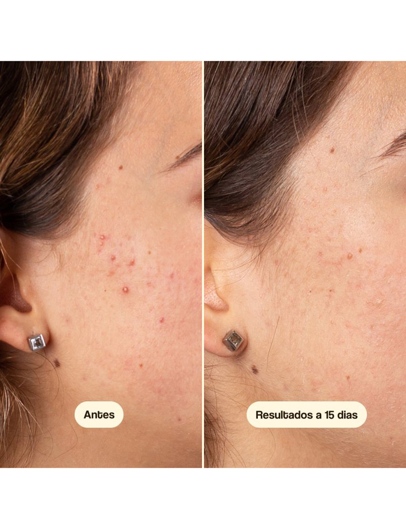 Azelaic Radiance Face Treatment