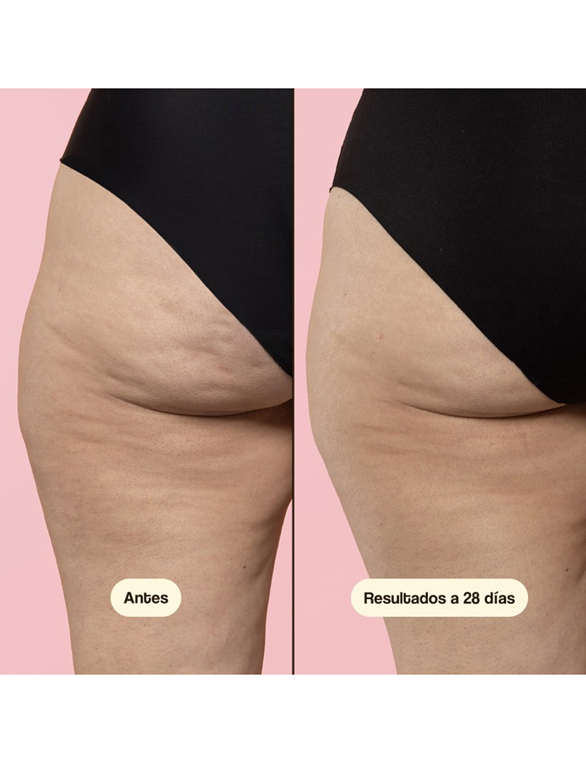 Beta-Burner Sculpting Treatment 